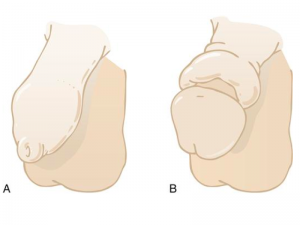 Phimosis | Prof. Dr. Coşkun Şahin