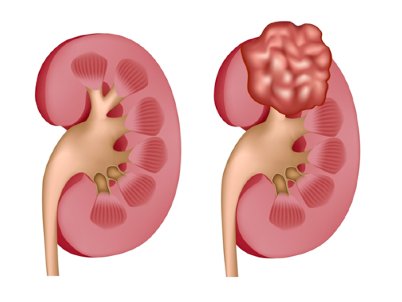 Böbrek Kanseri Ameliyatları