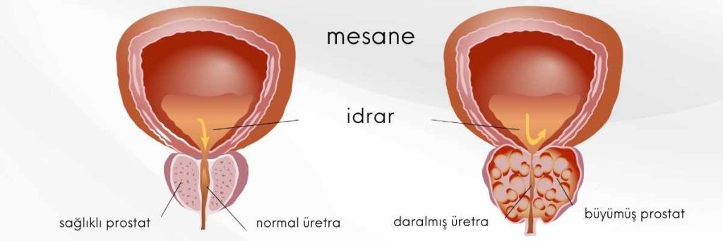 HoLEP ameliyatı SGK