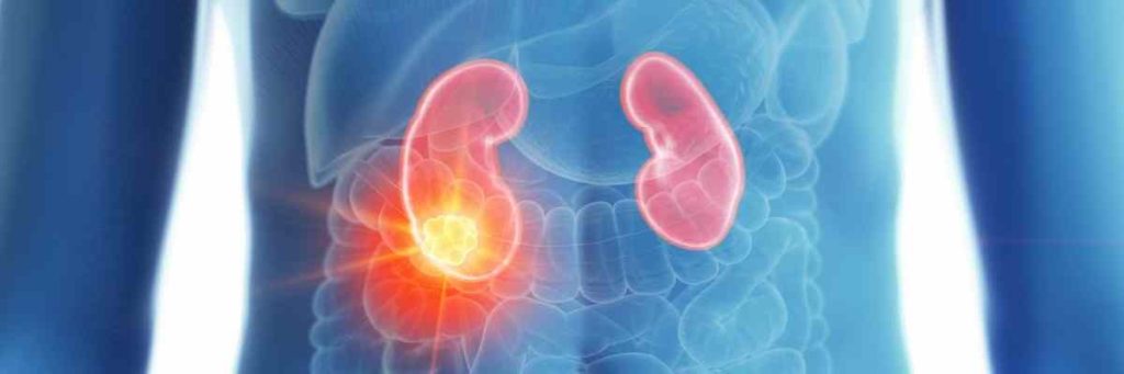 Böbrek Kanseri ve Tedavisi