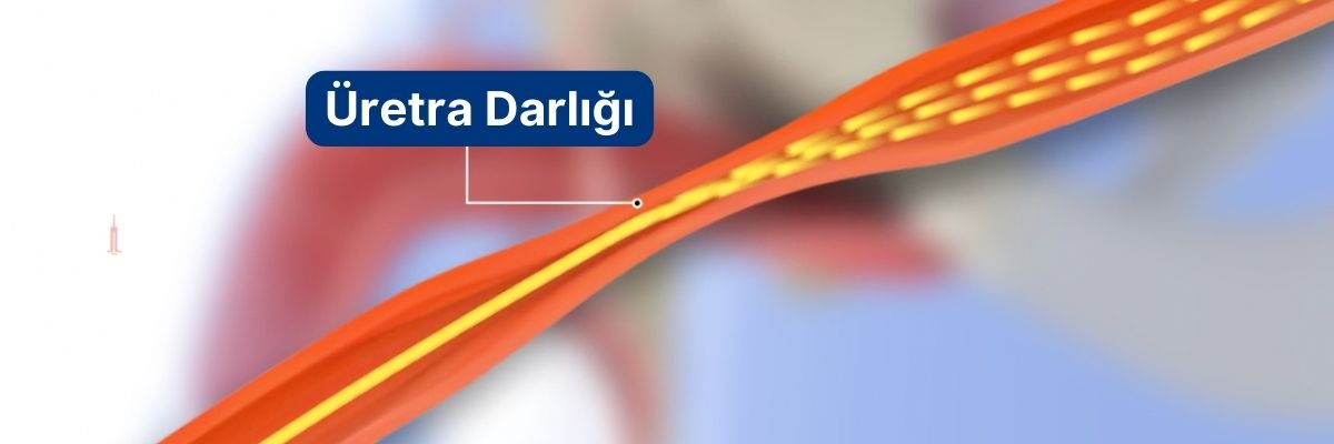 üretra darlığı