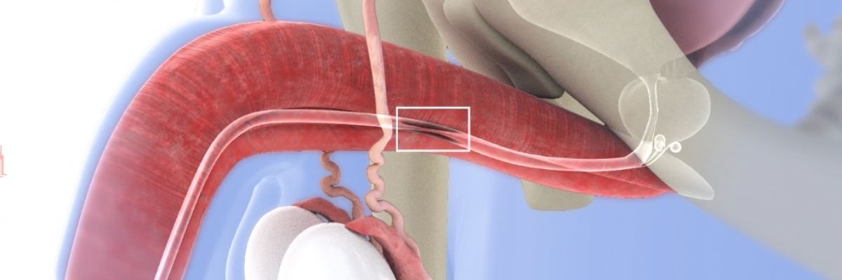 üretra darlığı nedir