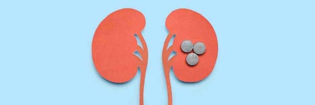 Perkütan Nefrolitotomi