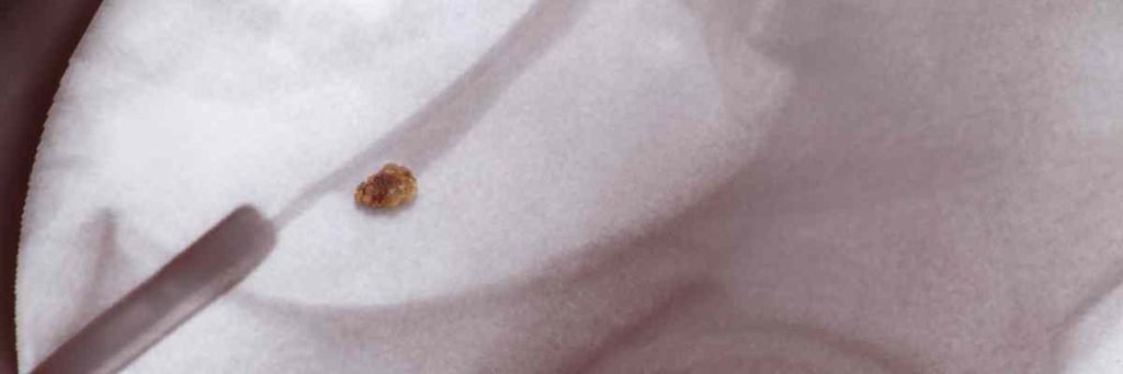 Böbrek Taşı Tedavisinde Üreteroskopi