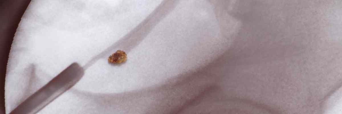 Böbrek Taşı Tedavisinde Üreteroskopi