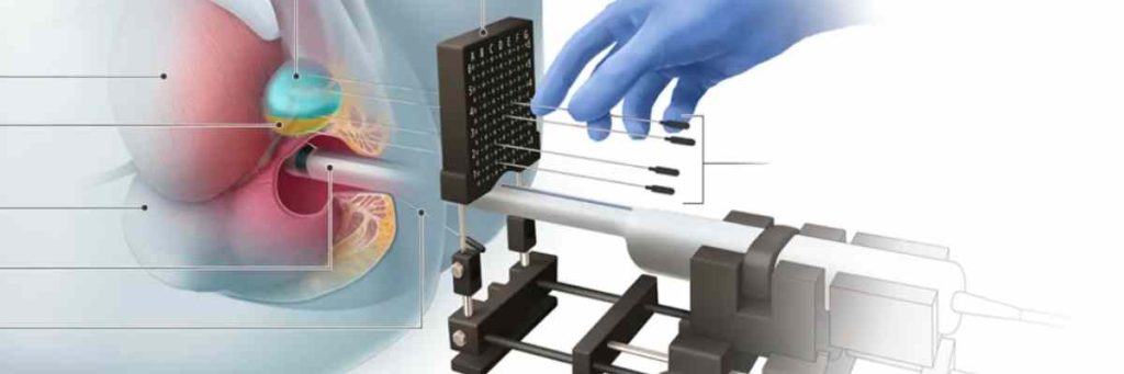 Prostat Biyopsisi Nedir?
