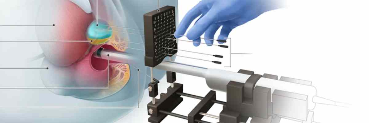 Prostat Biyopsisi Nedir?