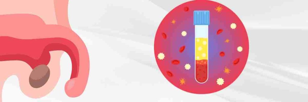 Ürolojide PRP P-Shot Tedavisi